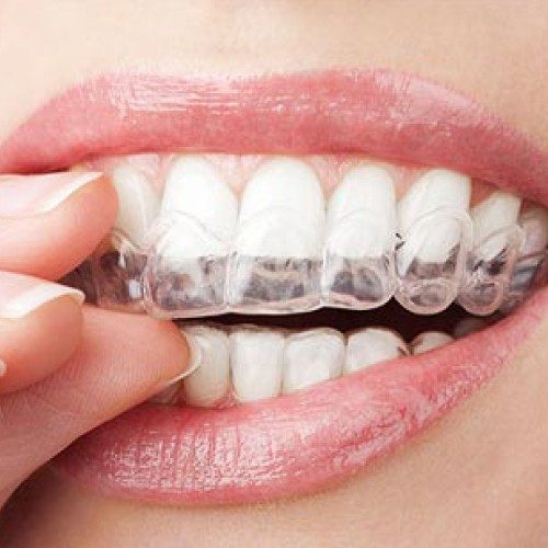 Revealing The Secrets Of Invisalign Braces